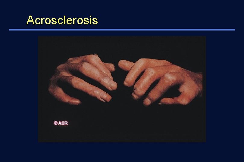 Acrosclerosis 