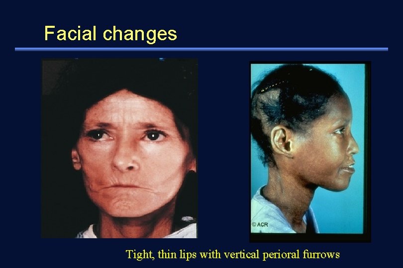 Facial changes Tight, thin lips with vertical perioral furrows 