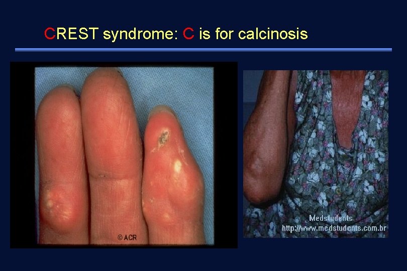 CREST syndrome: C is for calcinosis 