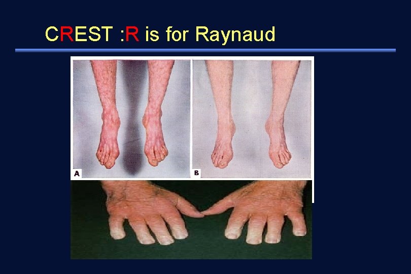 CREST : R is for Raynaud 