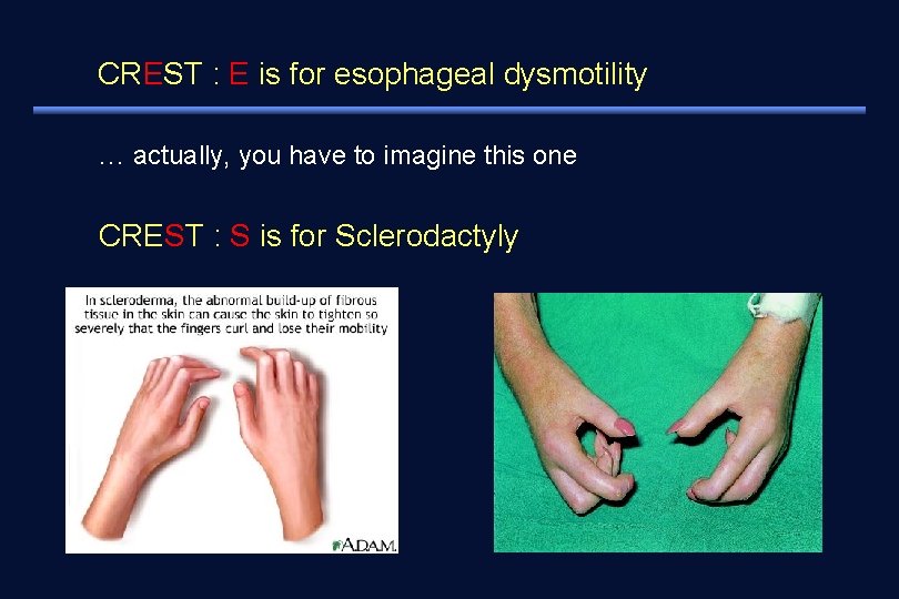 CREST : E is for esophageal dysmotility. . . actually, you have to imagine