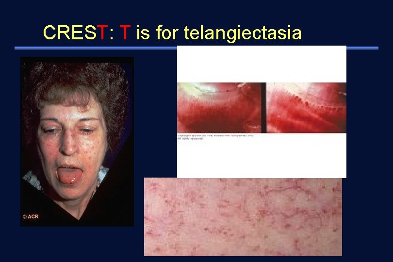 CREST: T is for telangiectasia 