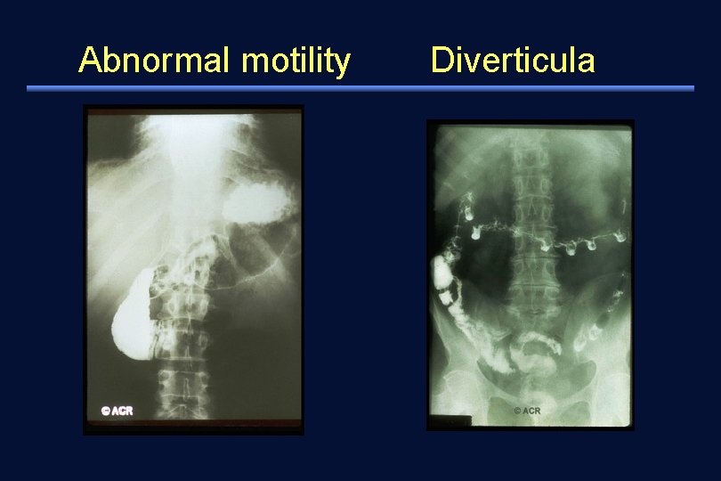 Abnormal motility Diverticula 