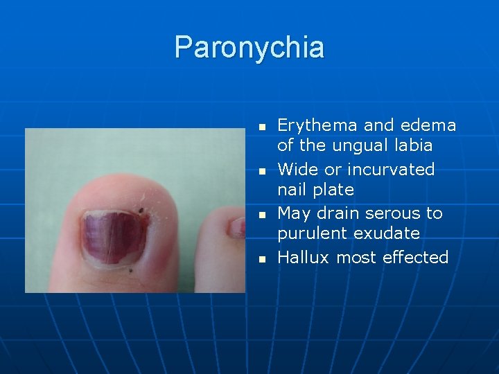 Paronychia n n Erythema and edema of the ungual labia Wide or incurvated nail