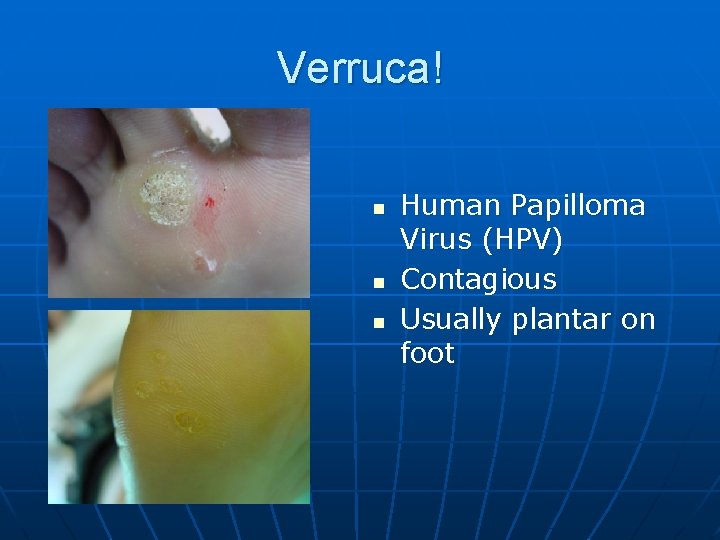 Verruca! n n n Human Papilloma Virus (HPV) Contagious Usually plantar on foot 