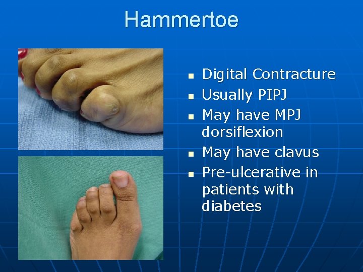 Hammertoe n n n Digital Contracture Usually PIPJ May have MPJ dorsiflexion May have