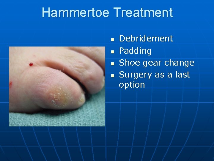 Hammertoe Treatment n n Debridement Padding Shoe gear change Surgery as a last option