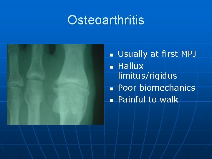 Osteoarthritis n n Usually at first MPJ Hallux limitus/rigidus Poor biomechanics Painful to walk