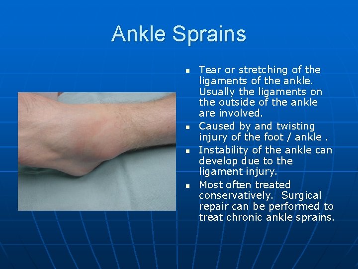 Ankle Sprains n n Tear or stretching of the ligaments of the ankle. Usually