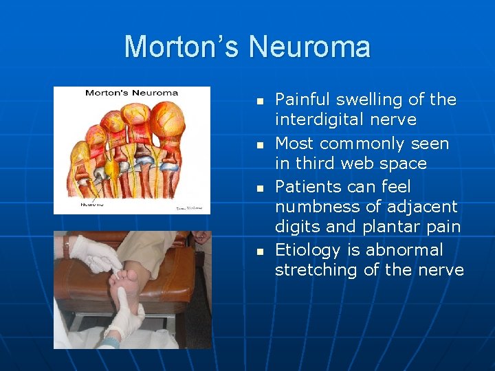 Morton’s Neuroma n n Painful swelling of the interdigital nerve Most commonly seen in