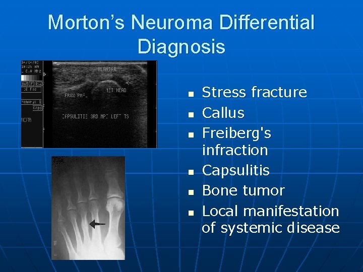 Morton’s Neuroma Differential Diagnosis n n n Stress fracture Callus Freiberg's infraction Capsulitis Bone