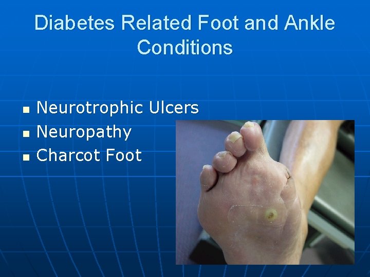 Diabetes Related Foot and Ankle Conditions n n n Neurotrophic Ulcers Neuropathy Charcot Foot