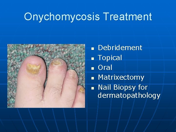 Onychomycosis Treatment n n n Debridement Topical Oral Matrixectomy Nail Biopsy for dermatopathology 