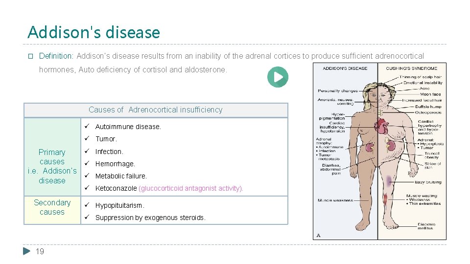 Addison's disease � Definition: Addison’s disease results from an inability of the adrenal cortices