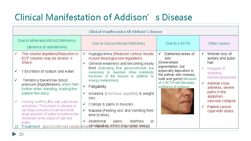 Clinical Manifestation of Addison’s Disease Clinical Manifestation Of Addison’s Disease Due to Mineralocorticoid Deficiency