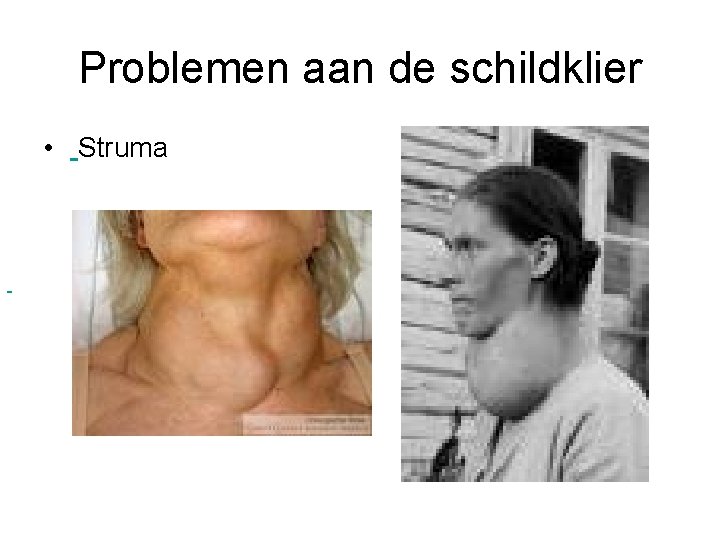 Problemen aan de schildklier • Struma 