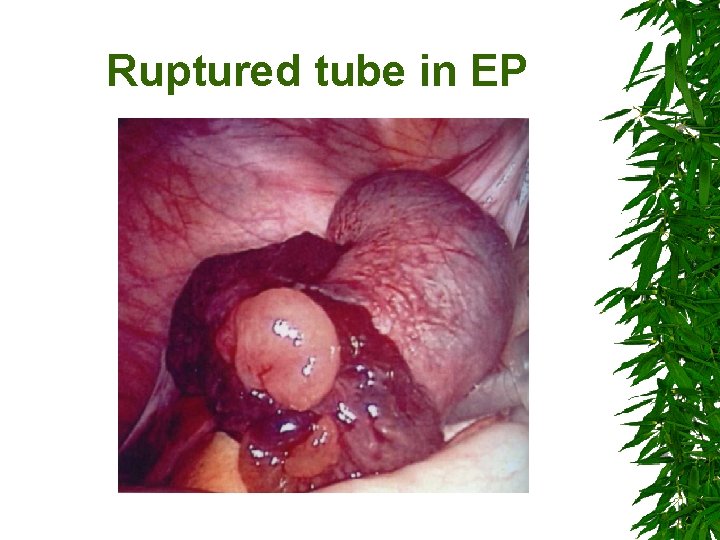 Ruptured tube in EP 