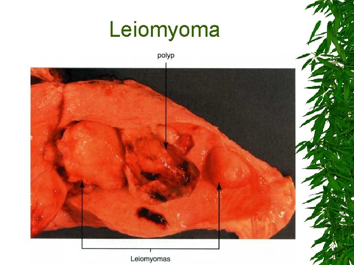 Leiomyoma 