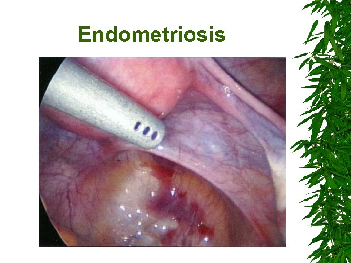 Endometriosis 