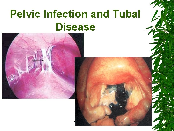 Pelvic Infection and Tubal Disease 43 