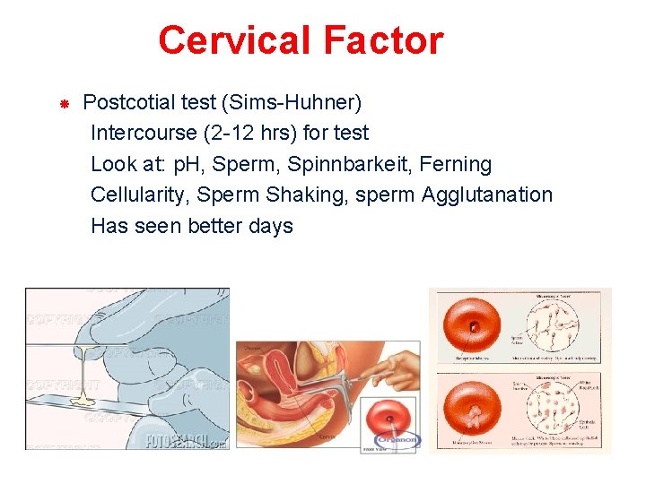 Cervical Factor Postcotial test (Sims-Huhner) Intercourse (2 -12 hrs) for test Look at: p.