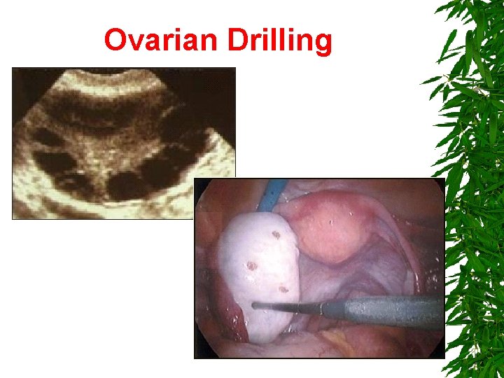 Ovarian Drilling 53 