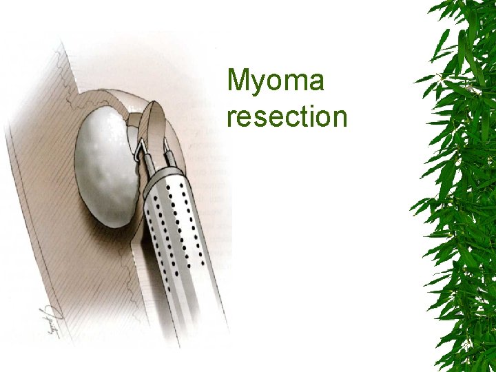 Myoma resection 