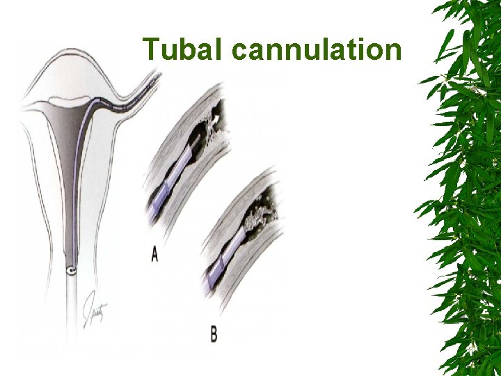 Tubal cannulation 