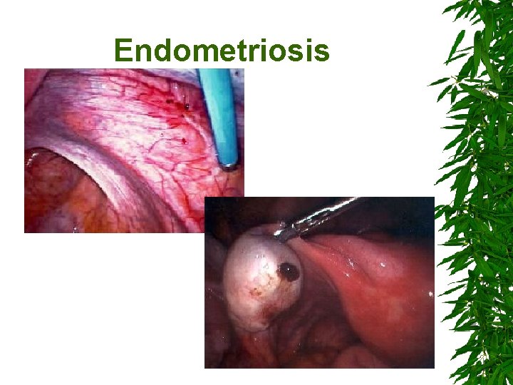 Endometriosis 61 