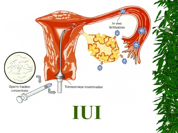 IUI 