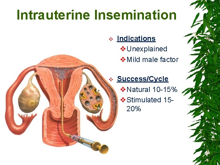 Intrauterine Insemination 69 v Indications v. Unexplained v. Mild male factor v Success/Cycle v.