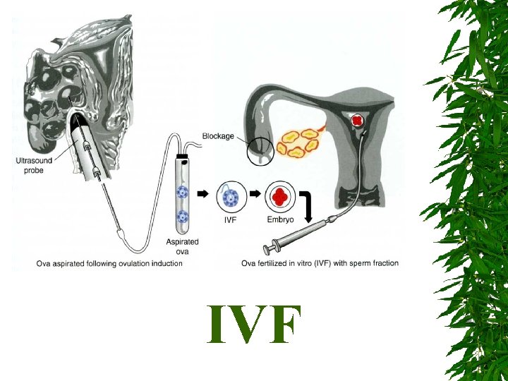IVF 