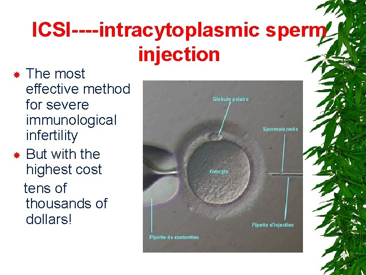 ICSI----intracytoplasmic sperm injection The most effective method for severe immunological infertility But with the