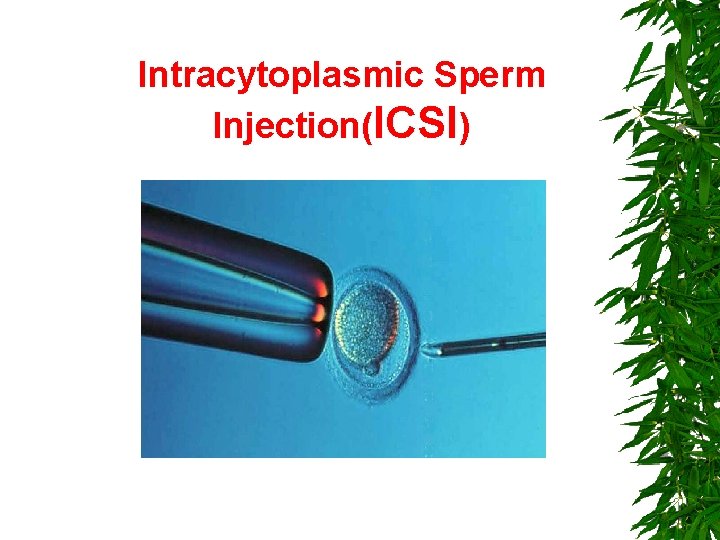 Intracytoplasmic Sperm Injection(ICSI) 