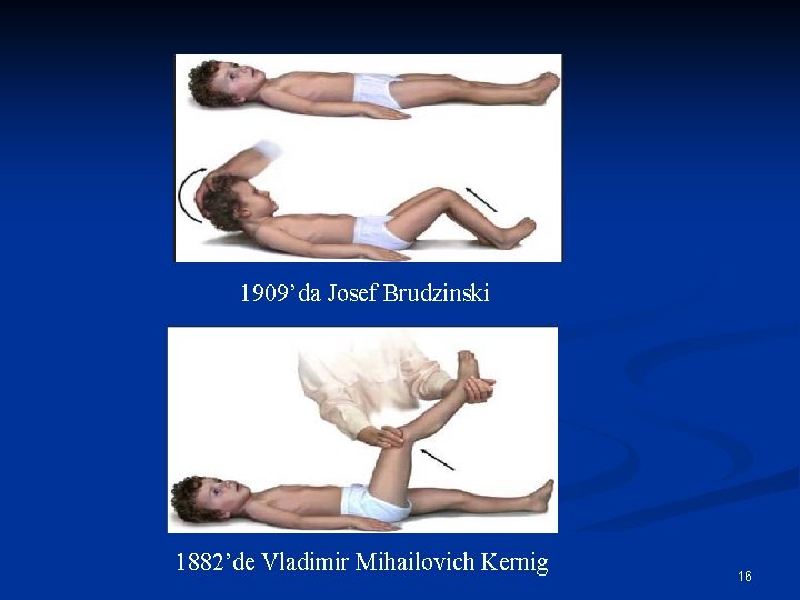 1909’da Josef Brudzinski 1882’de Vladimir Mihailovich Kernig 16 