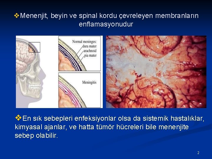 v. Menenjit, beyin ve spinal kordu çevreleyen membranların enflamasyonudur v. En sık sebepleri enfeksiyonlar