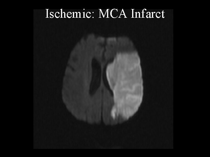 Ischemic: MCA Infarct 