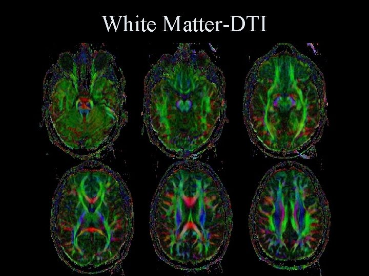 White Matter-DTI 