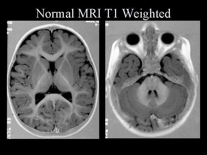 Normal MRI T 1 Weighted 