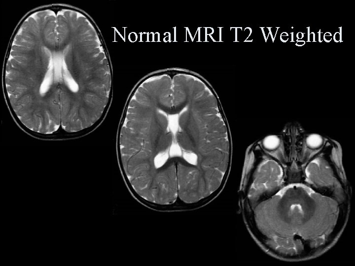 Normal MRI T 2 Weighted 