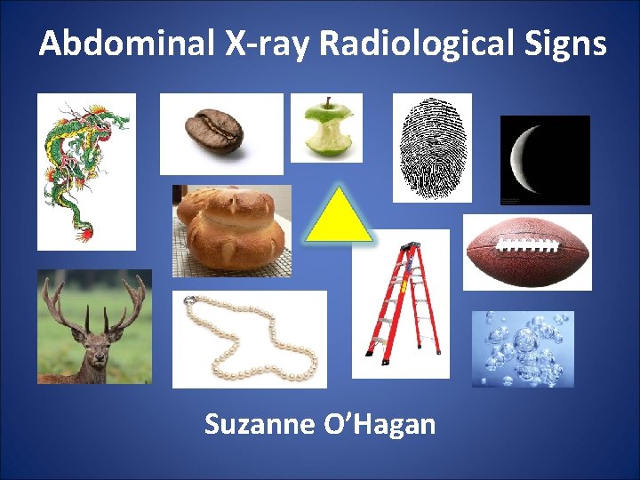Abdominal X-ray Radiological Signs Suzanne O’Hagan 