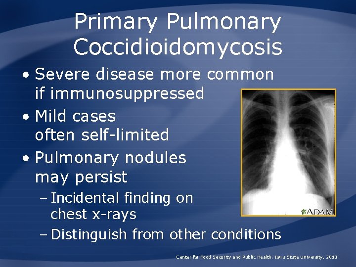 Primary Pulmonary Coccidioidomycosis • Severe disease more common if immunosuppressed • Mild cases often
