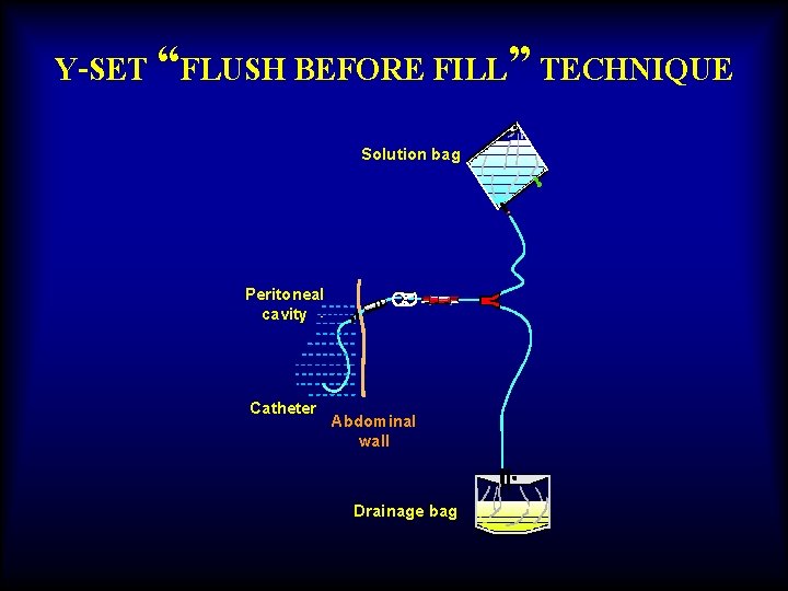 Y-SET “FLUSH BEFORE FILL” TECHNIQUE Solution bag Peritoneal cavity Catheter Abdominal wall Drainage bag