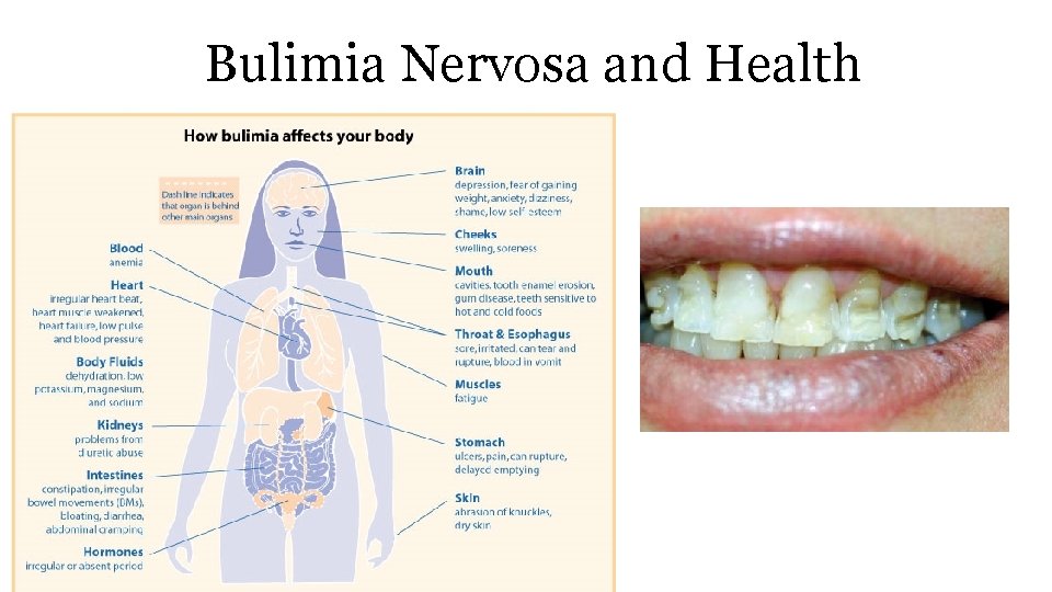 Bulimia Nervosa and Health 
