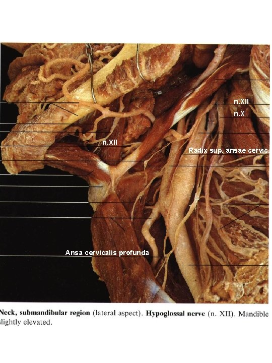 n. XII Radix sup. ansae cervic. Ansa cervicalis profunda 