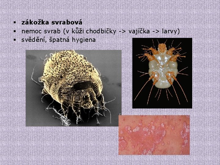 § zákožka svrabová § nemoc svrab (v kůži chodbičky -> vajíčka -> larvy) § § zákožka svrabová § nemoc svrab (v kůži chodbičky -> vajíčka -> larvy) §
