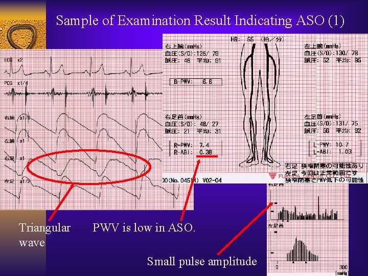 Sample of Examination Result Indicating ASO (1) Triangular wave PWV is low in ASO.