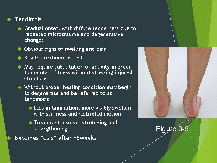  Tendinitis Gradual onset, with diffuse tenderness due to repeated microtrauma and degenerative changes