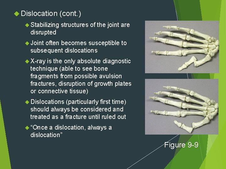  Dislocation Stabilizing (cont. ) structures of the joint are disrupted Joint often becomes