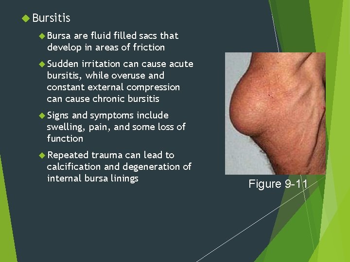  Bursitis Bursa are fluid filled sacs that develop in areas of friction Sudden